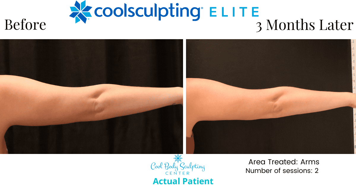 Reduce arm Fat in Virginia Beach Non invasive No Surgery Liposuction Sono Bello Fat Reduction in Virginia Beach Before and After on Arms Reduce Arm Fat Liposuction Sono Bello Non Invasive No Surgery