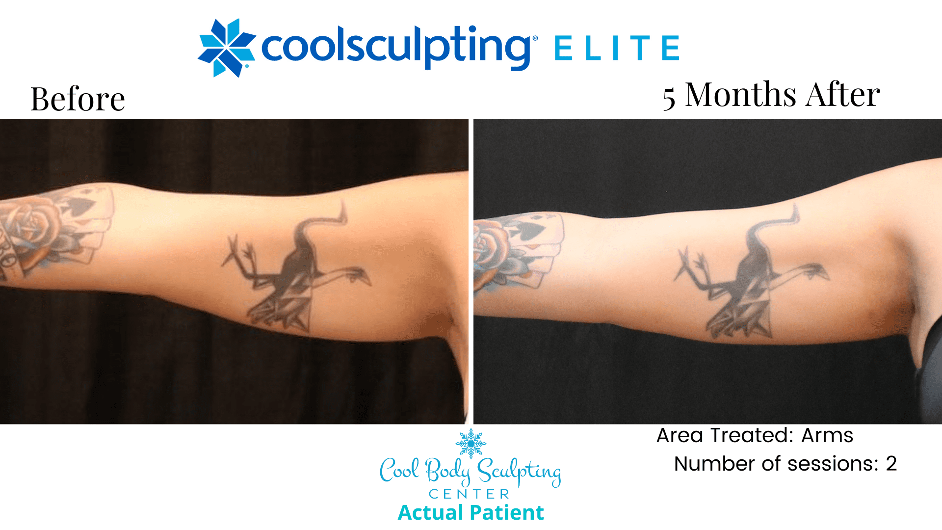 at Reduction in Virginia Beach Before and After on Arms Reduce Arm Fat Liposuction Sono Bello Non Invasive No Surgery Fat Reduction in Virginia Beach Before and After on Arms Reduce Arm Fat Liposuction Sono Bello Non Invasive No Surgery