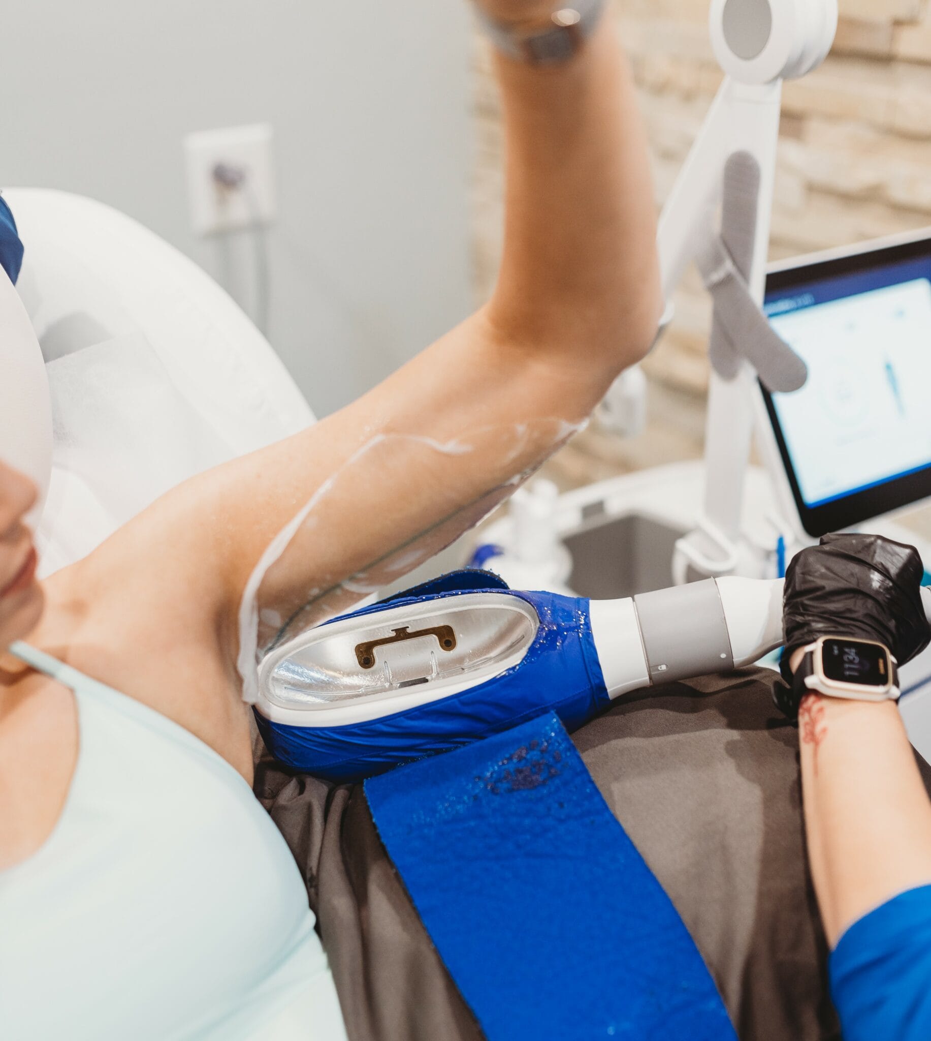CoolSculpting arms