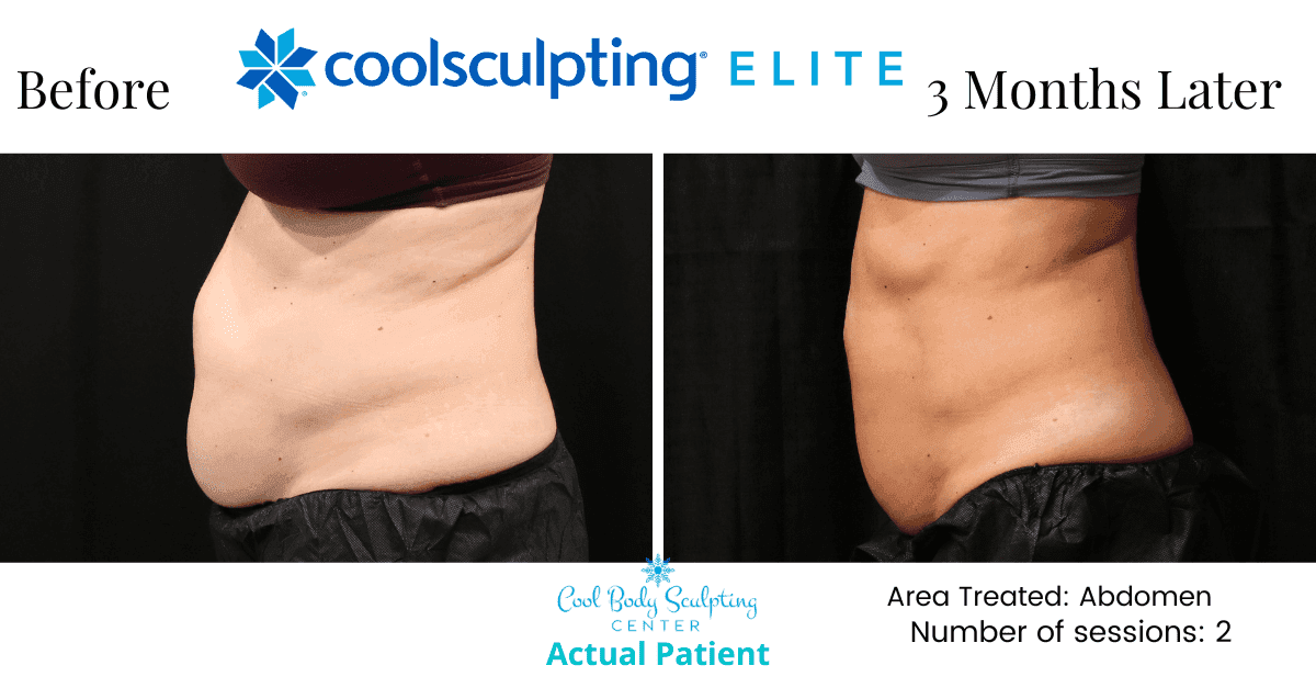 coolsculpting stomach Non-invasive fat reduction on thighs using CoolSculpting in Virginia Beach with visible contouring results