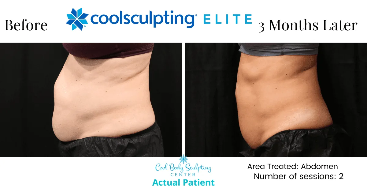 coolsculpting stomach Non-invasive fat reduction on thighs using CoolSculpting in Virginia Beach with visible contouring results