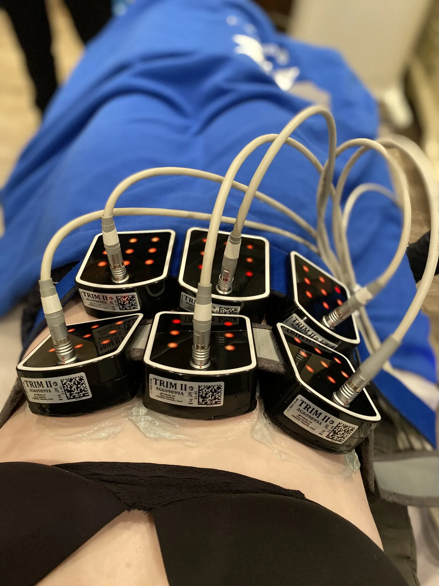 Evolve Transform Procedure In Virginia Beach Evolve Transform Treatment being performed on an abdomen in Virginia Beach for non invasive fat reduction procedure in Virginia Beach