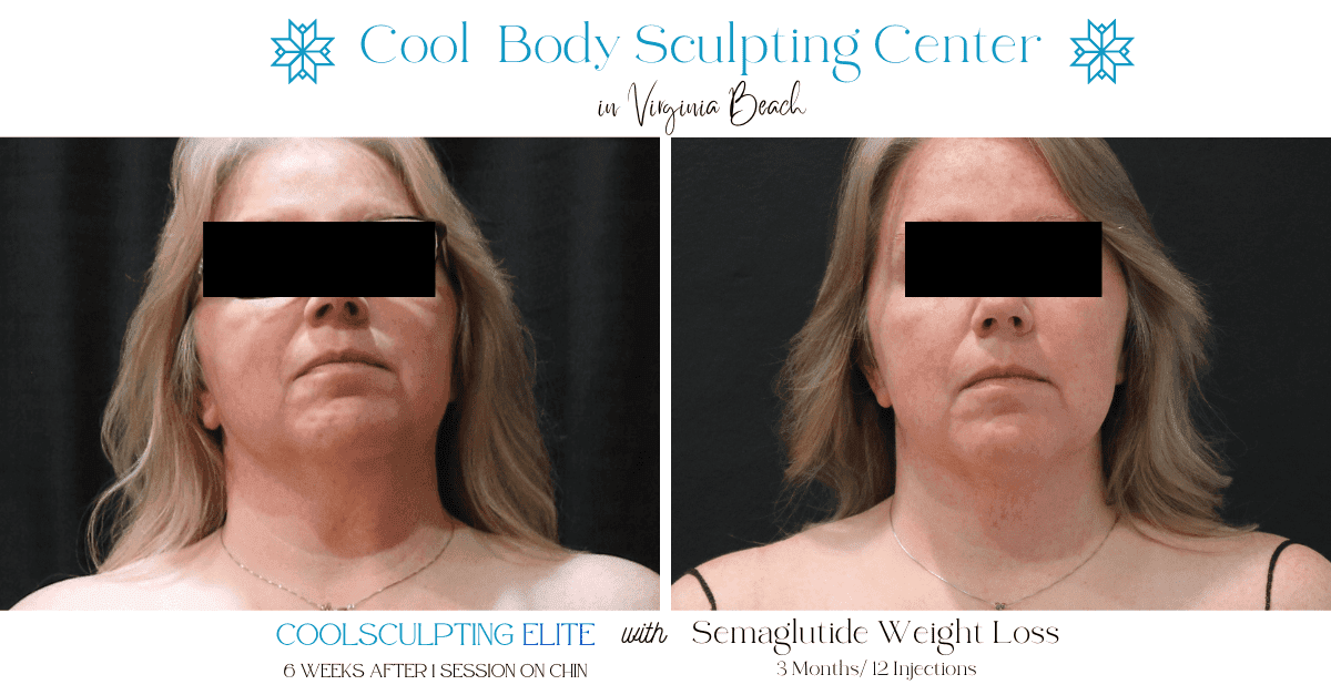 chin lipo, weight loss on face, ozempic virginia beach chin lipo, weight loss on face, ozempic virginia beach