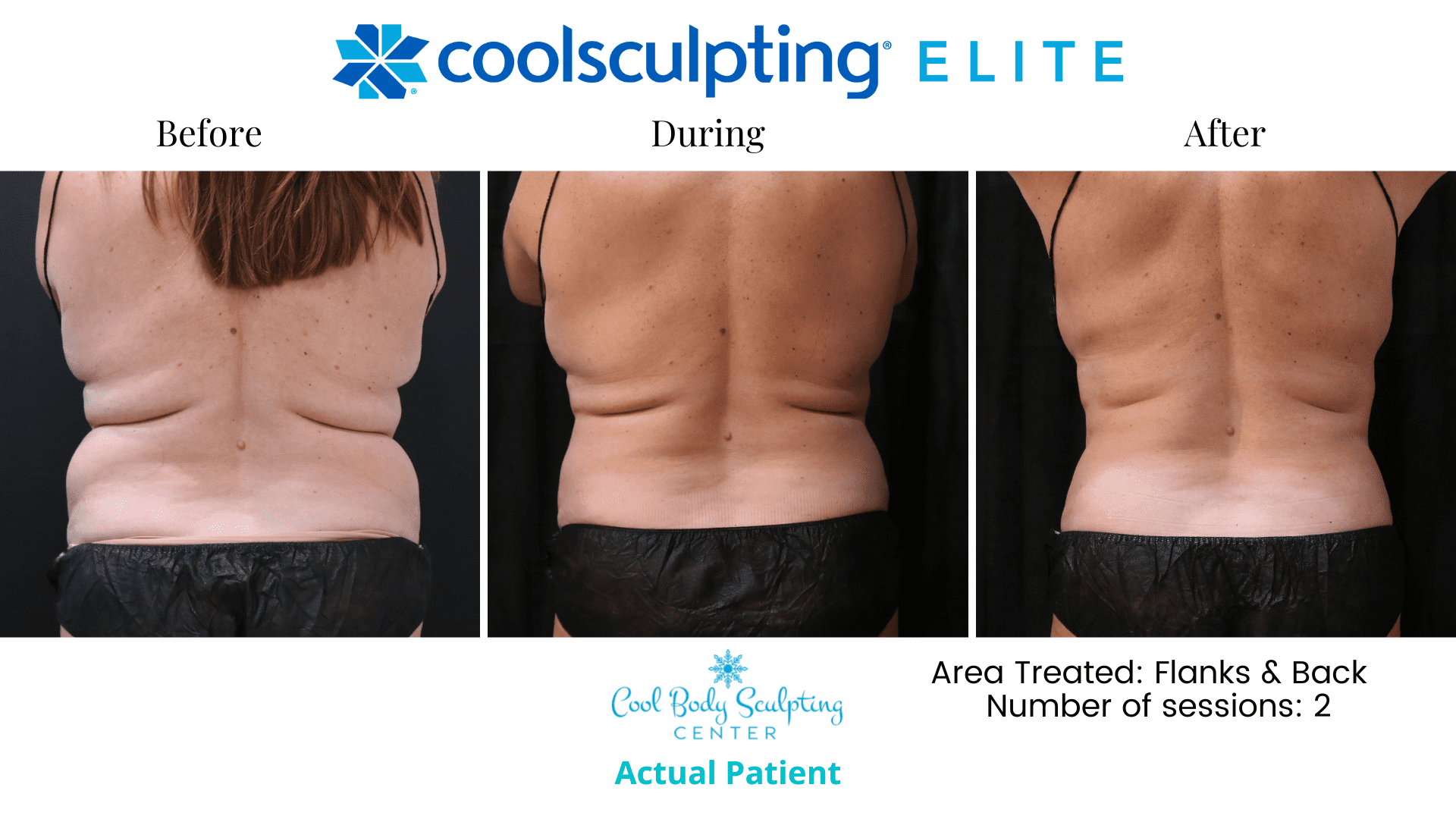 Liposuction in Virginia Beach, How to get rid of love handles men, love handles, exercises to get rid of love handles, love handle reduction Liposuction in Virginia Beach Liposuction in Virginia Beach, How to get rid of love handles men, love handles, exercises to get rid of love handles, love handle reduction