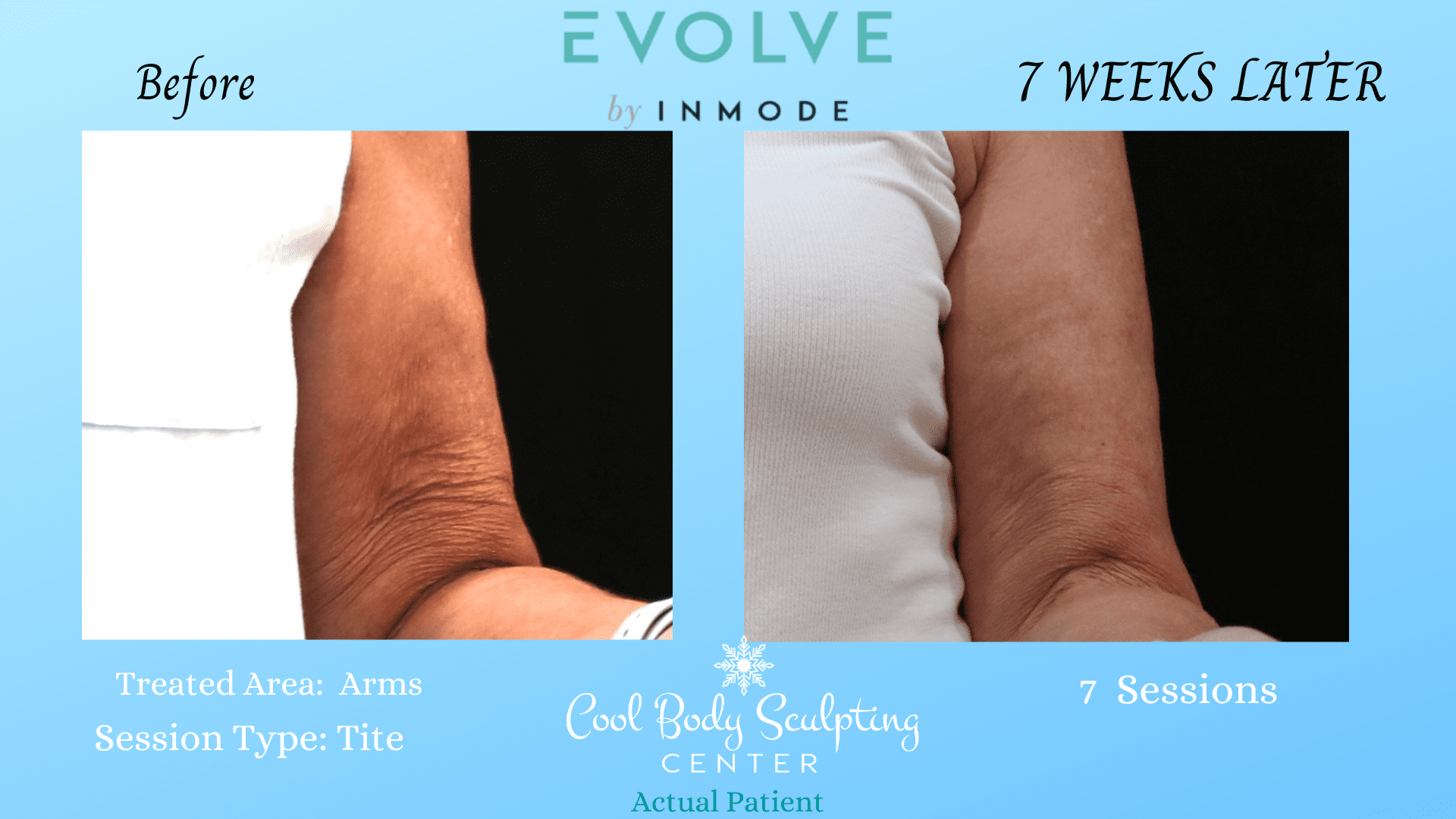Skin Tightening on arms in Virginia Beach Skin Tightening Cellulite Reduction Get Rid of Cellulite in Virginia Beach Prevent Sagging Skin Get Rid of Sagging Skin