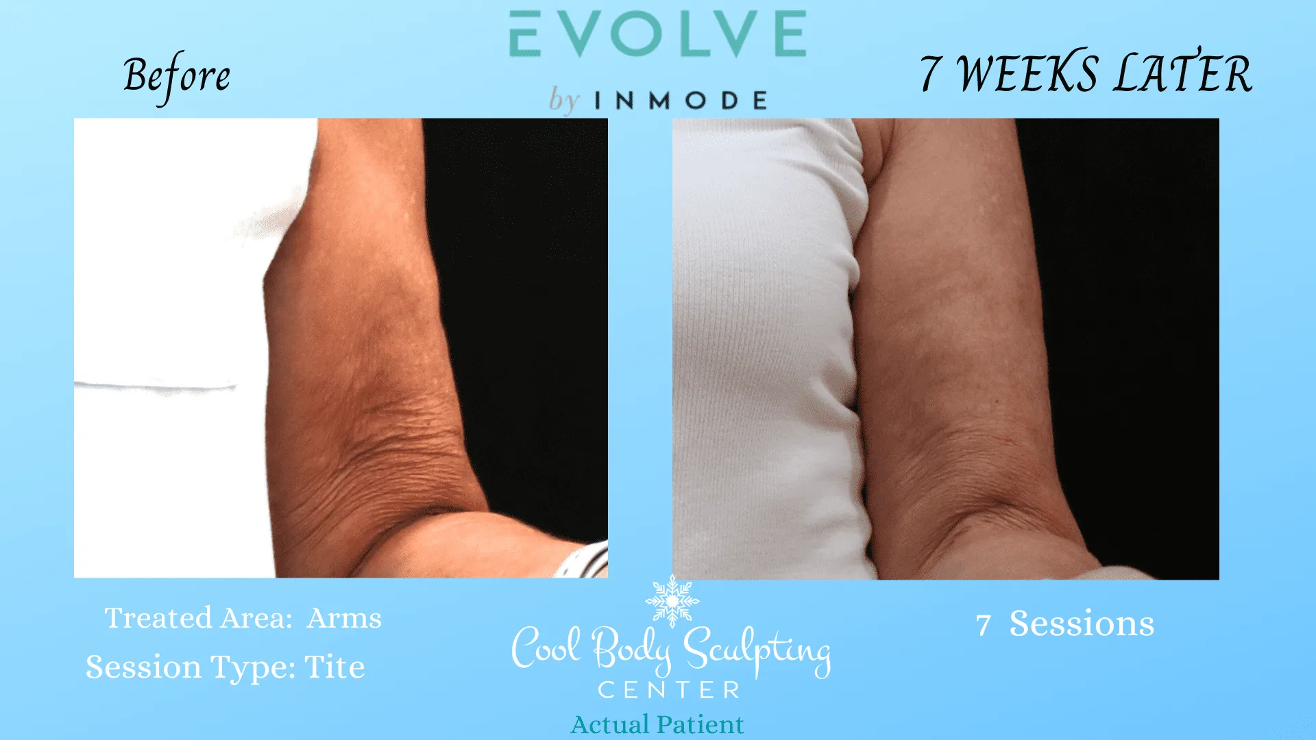 skin tightening on arms skin tightening in Virginia beach