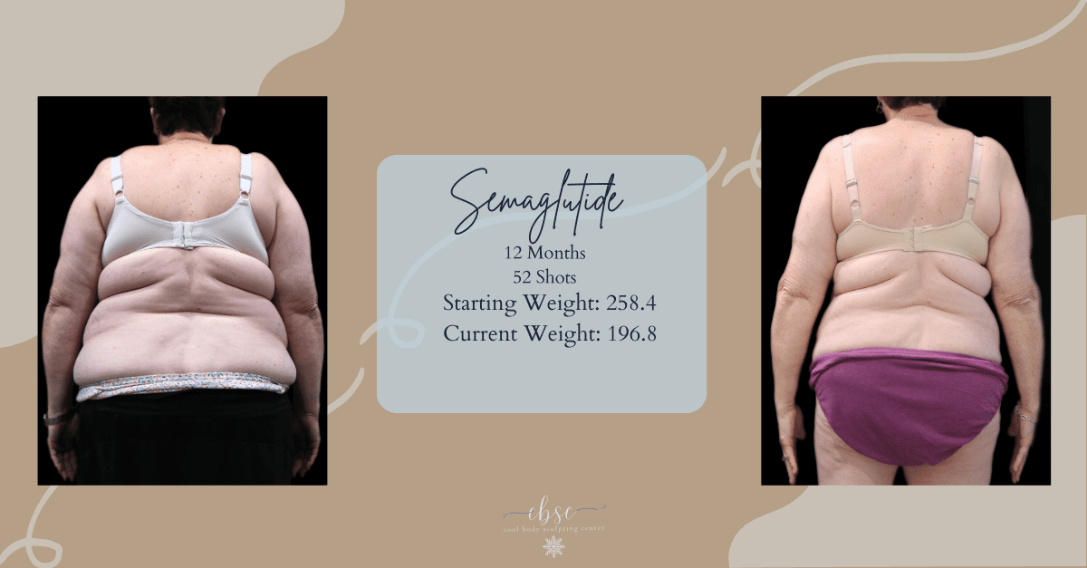Female Weight Loss Before and After Before and After Woman in Virginia Beach Losing Weight Body Fat from Semaglutide Weightloss Shots