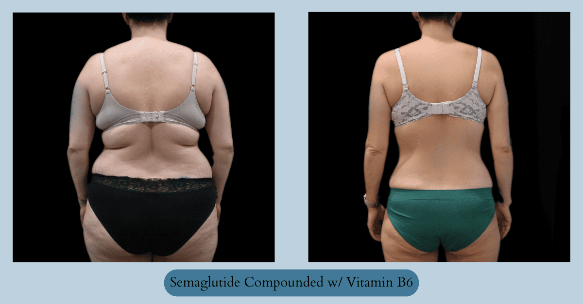 Semaglutide in Virginia Beach Fat Loss Before and After of Woman on Semaglutide for 52 weeks at Cool Body Sculpting Center in Virginia Beach Fat Loss Weight Loss