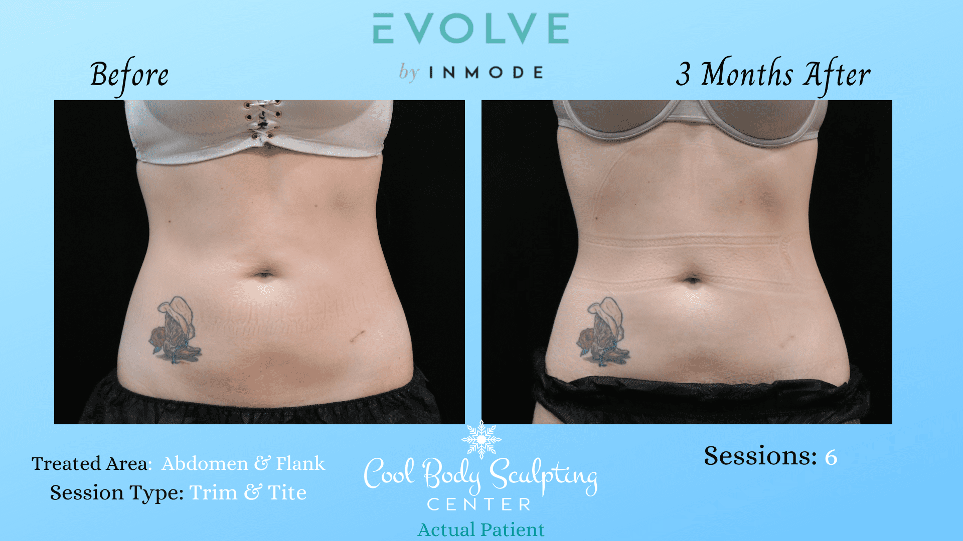 Lose Flanks Lose Love Handles Liposuction SonoBello Virginia Beach Lose love handles men Lose Flanks Lose Love Handles Liposuction SonoBello Virginia Beach Lose love handles men