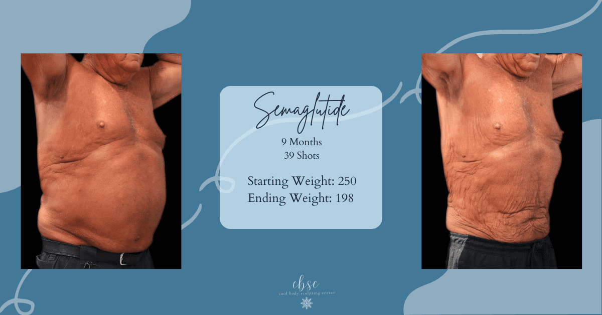 Before and After Male Weightloss in Virginia Beach Before And After of Man Losing Weight Body Fat on Semaglutide at Cool Body Sculpting Center in Virginia Beach VA