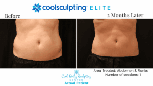 Love Handle Reduction how to get rid of love handles men Coolsculpting Elite Ozempic Virginia Beach
