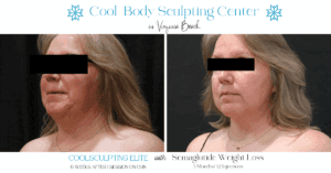 CoolSculpting Elite chin treatment for chin fat reduction in Virginia Beach