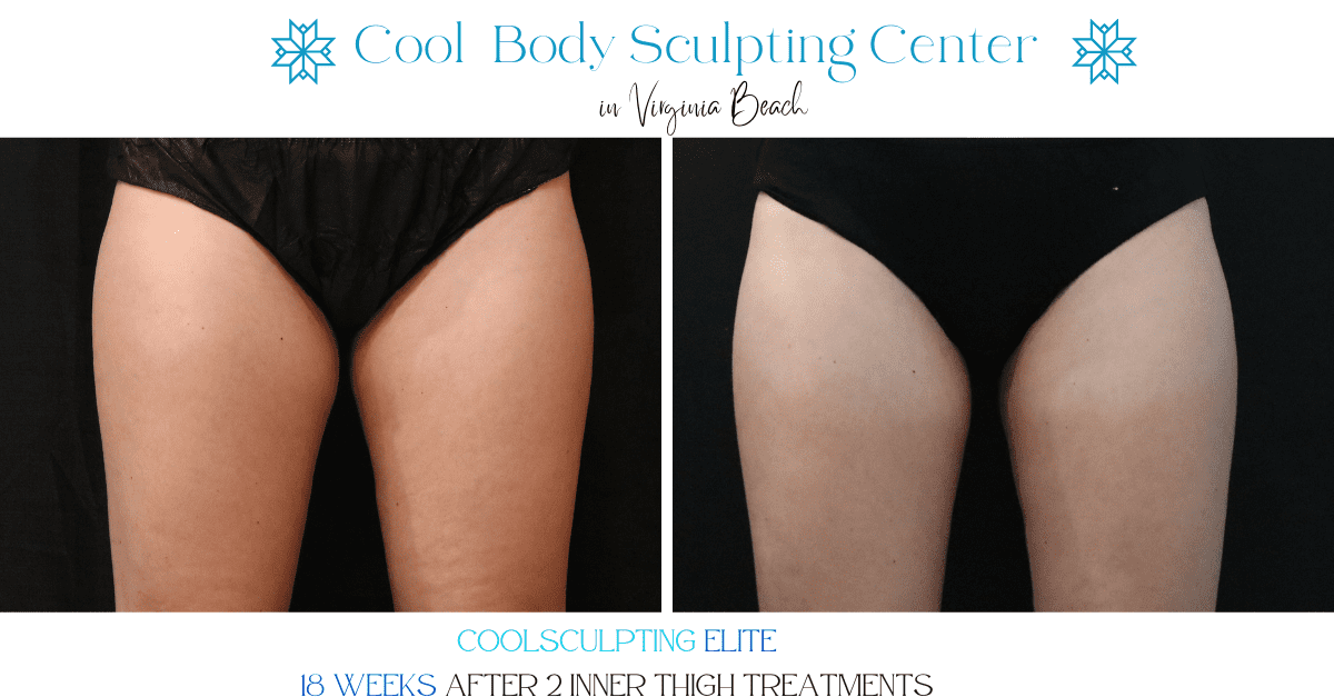 Thigh Fat Reduction Inner Thigh Reduction Thigh Fat Reduction Virginia Beach LipoSuction Ozempic Weight lOSS
