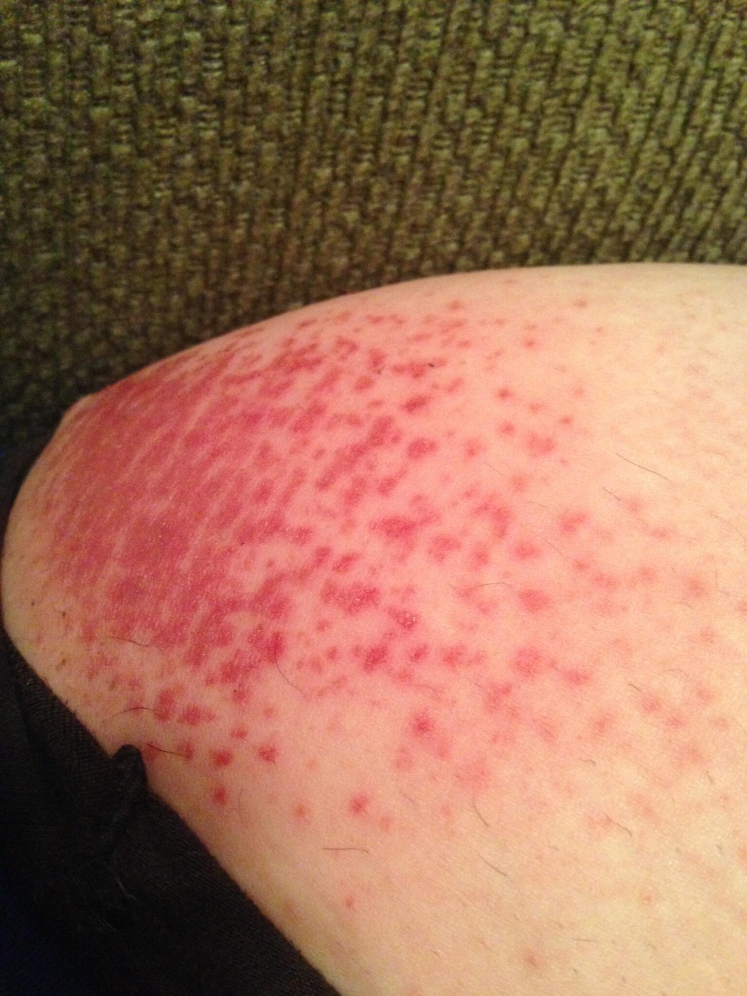 Photo taken from Reddit; chub rub on inner thigh