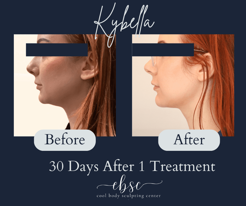 Kybella double chin injection at Cool Body Sculpting Center Hampton Roads Kybella double chin injection at Cool Body Sculpting Center Hampton Roads