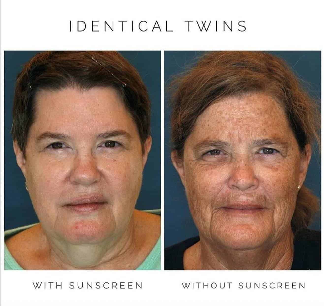 SkinMedica TNS Serum and Neck Correct used post chin fat reduction SkinMedica TNS Serum and Neck Correct used post chin fat reduction