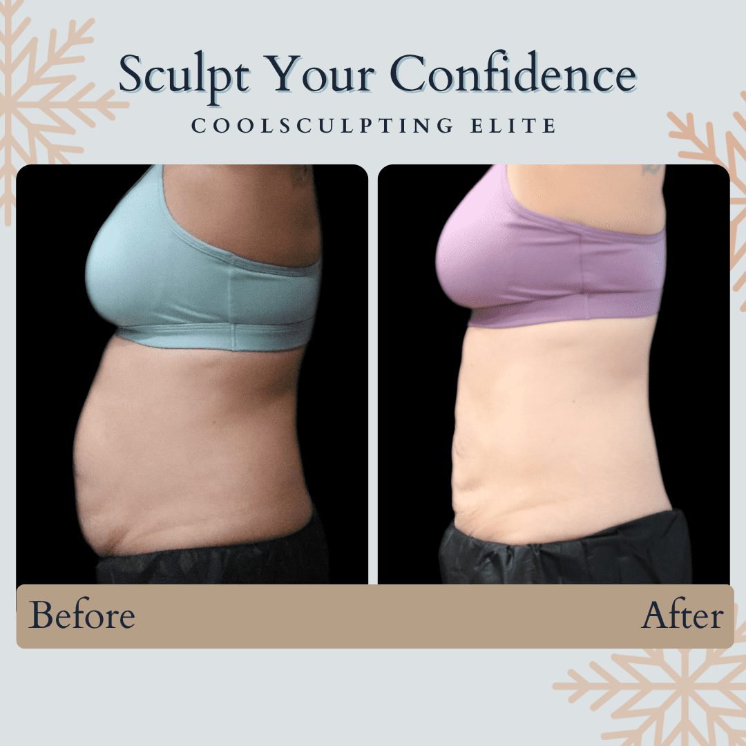 Lose Belly Fat in Virginia Beach Lose Belly Fat in Virginia Beach Semaglutide Ozempic Wegovy Liposuction Sonobello