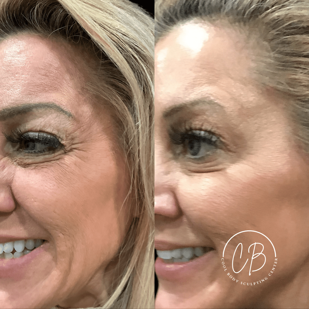 Botox Crow’s Feet Before and After – Virginia Beach Before and after Botox crow’s feet treatment showing smoother eye area at Cool Body Sculpting Center Virginia Beach.