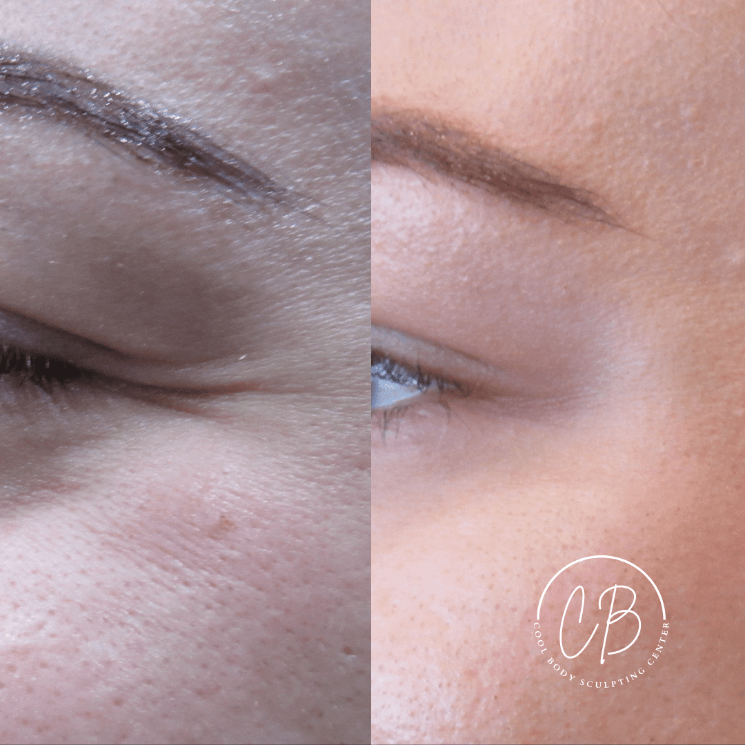 Botox Crow’s Feet Before and After – Virginia Beach Before and after Botox crow’s feet treatment showing smoother eye area at Cool Body Sculpting Center Virginia Beach.