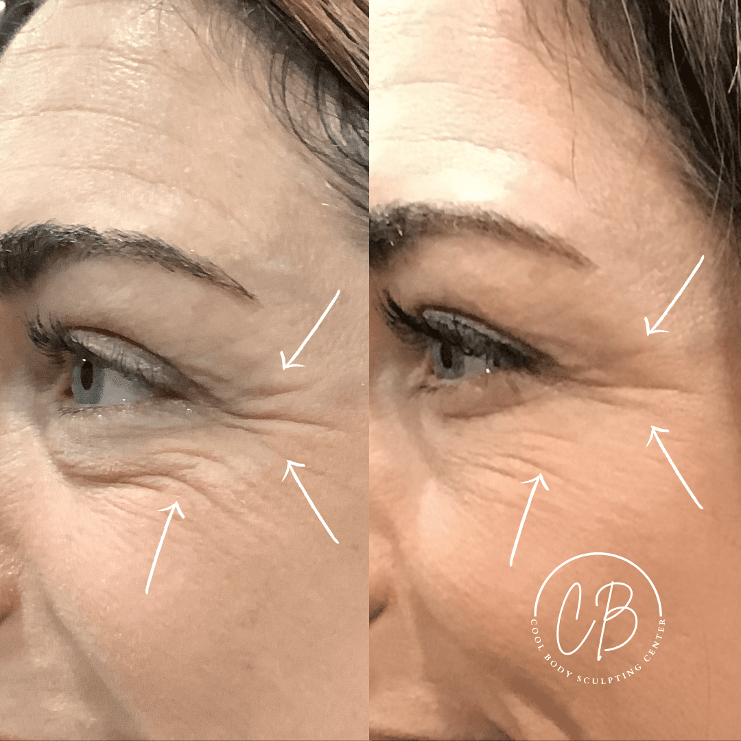 Botox Crow’s Feet Before and After – Virginia Beach Before and after Botox crow’s feet treatment showing smoother eye area at Cool Body Sculpting Center Virginia Beach.