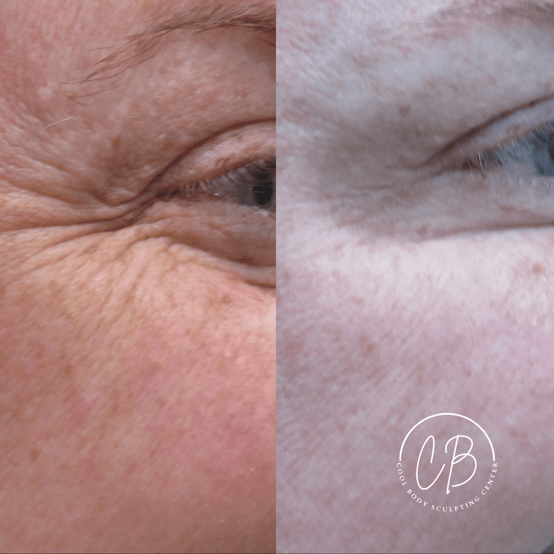 Botox Crow’s Feet Before and After – Virginia Beach Before and after Botox crow’s feet treatment showing smoother eye area at Cool Body Sculpting Center Virginia Beach.