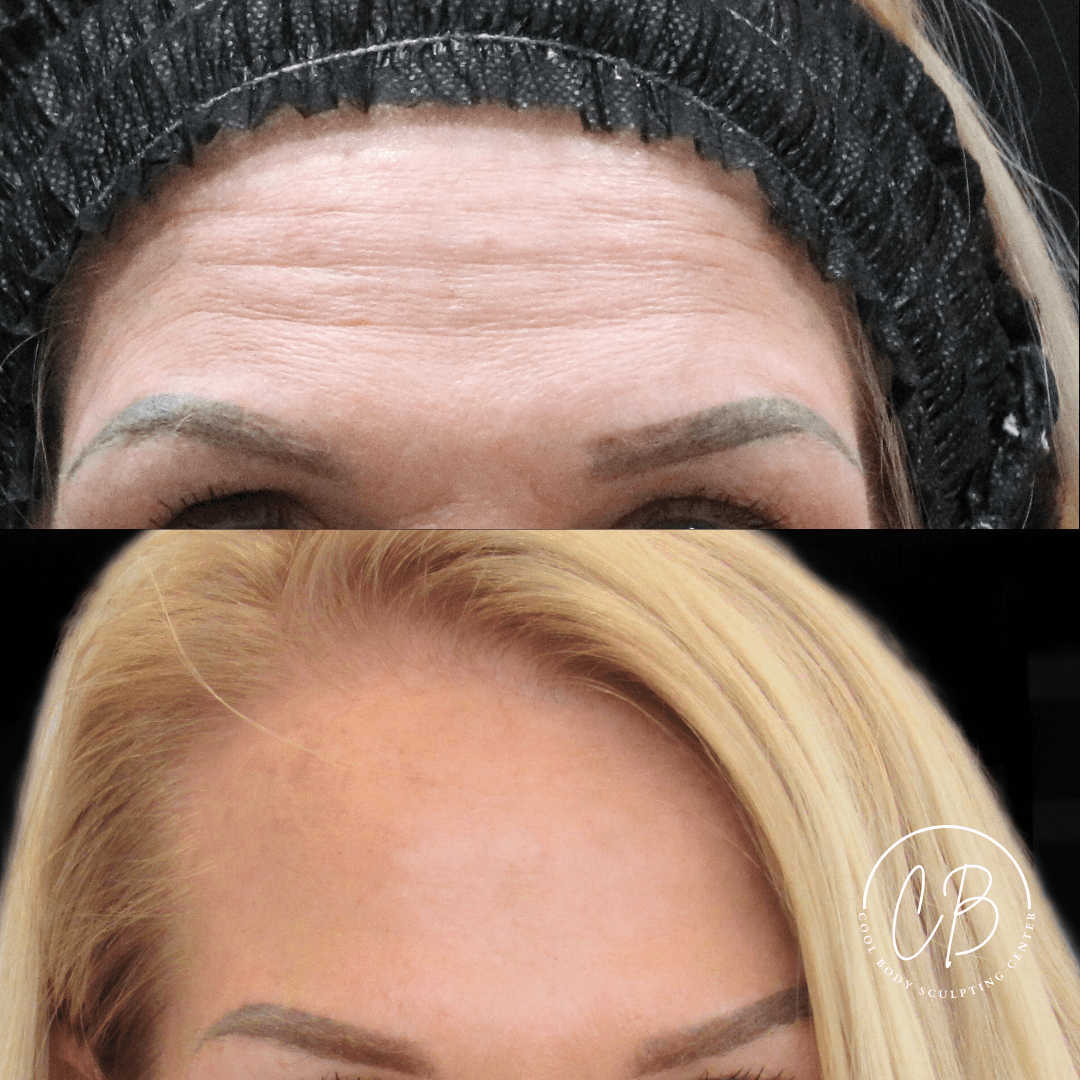 Botox Forehead Lines Before and After – Virginia Beach Before and after Botox forehead treatment showing reduced fine lines in Virginia Beach.