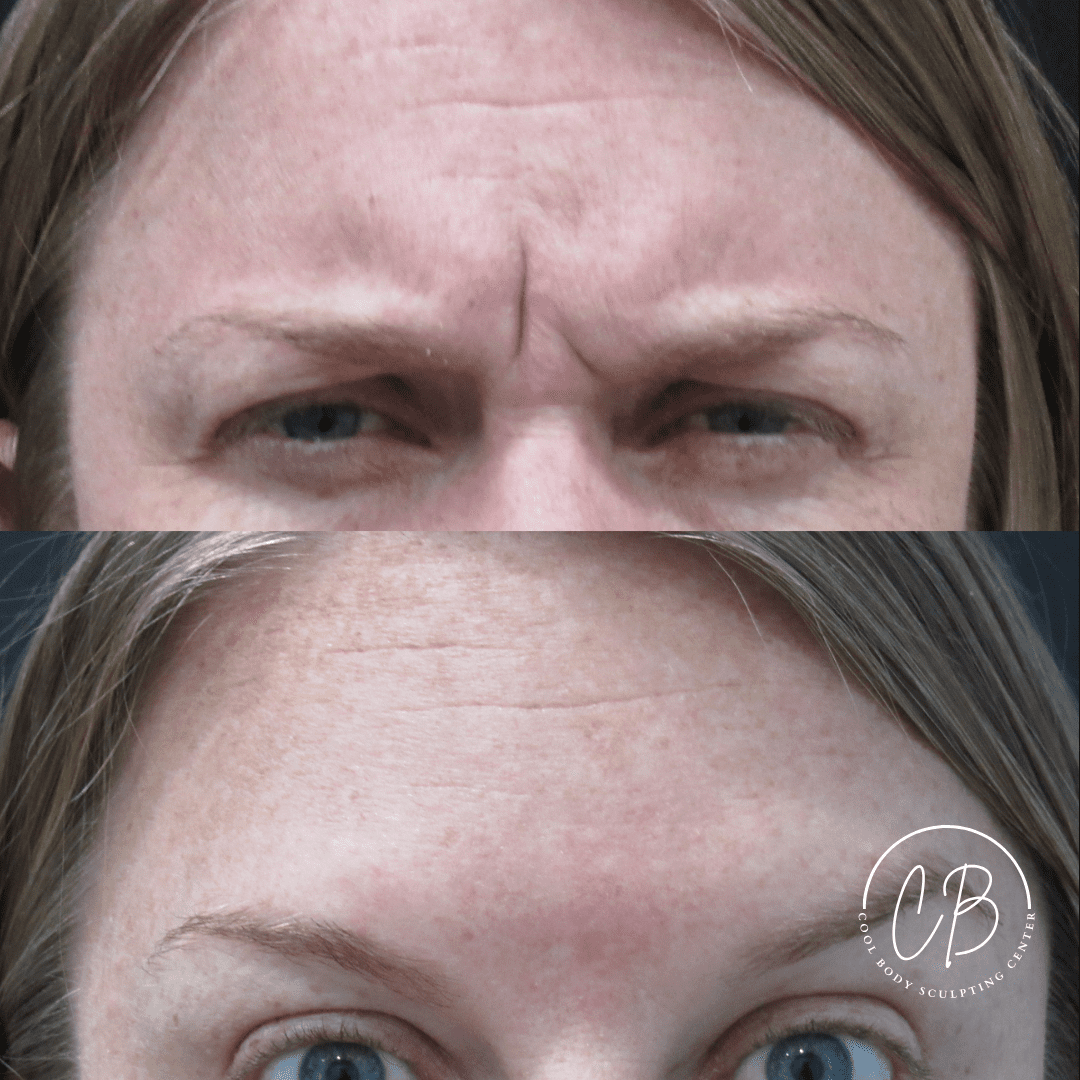 Botox Forehead Lines Before and After – Virginia Beach Before and after Botox forehead treatment showing reduced fine lines in Virginia Beach.
