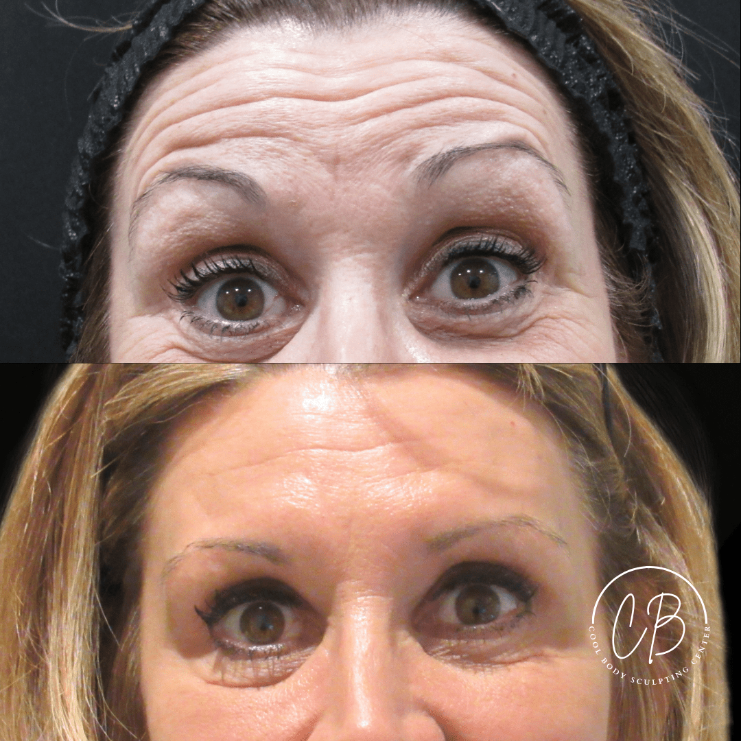Botox Forehead Lines Before and After – Virginia Beach Before and after Botox forehead treatment showing reduced fine lines in Virginia Beach.