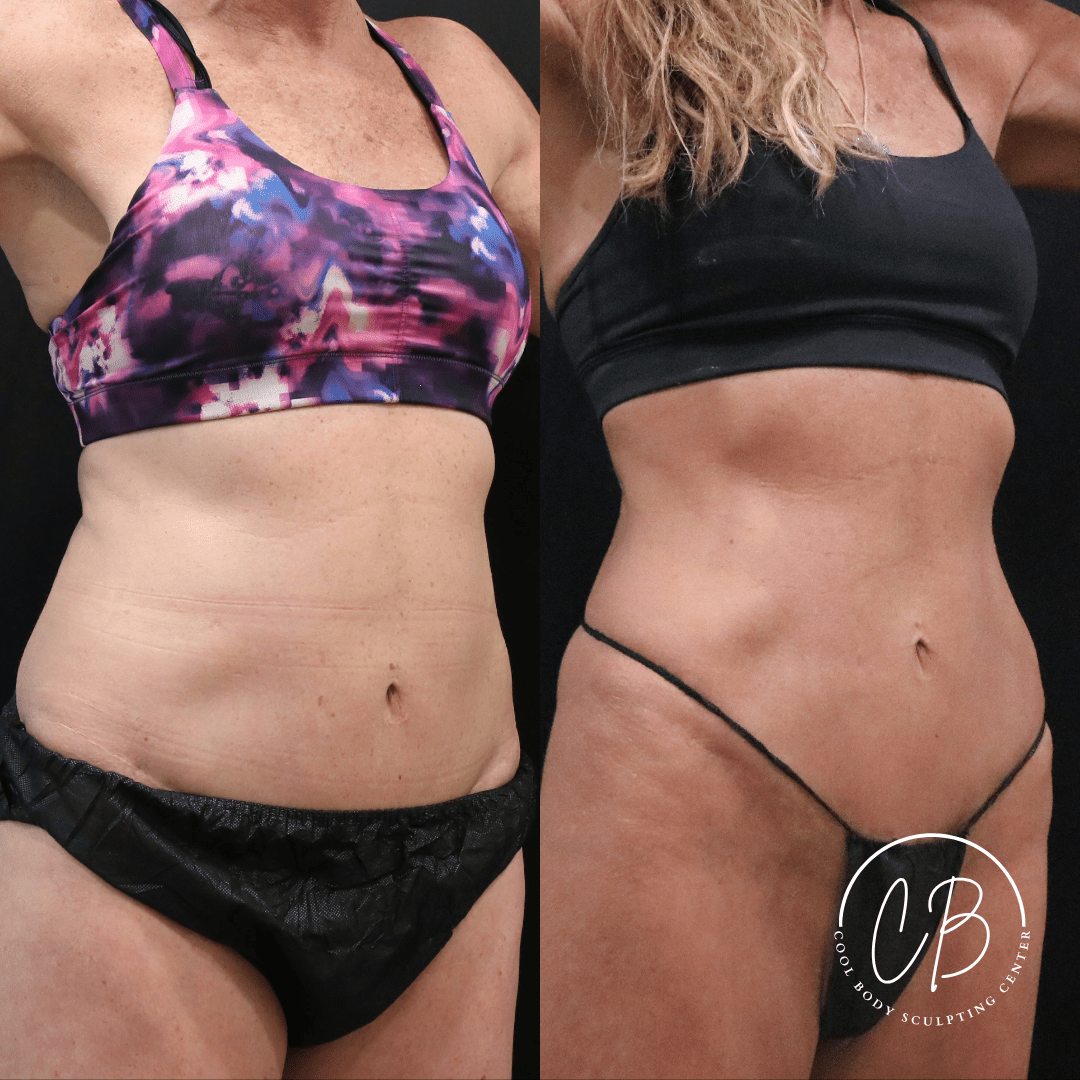 Before and after InMode Tone abdomen treatment showing tighter, toned core in Virginia Beach.